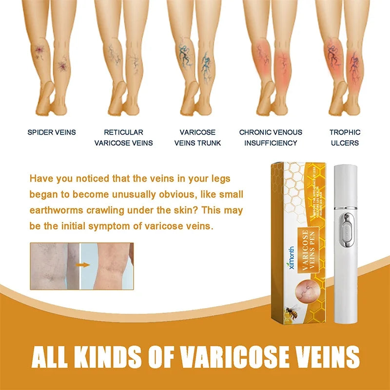 Laser Therapy Pen for Varicose Veins | Blue Light Treatment Device for Pain Relief & Circulation Improvement