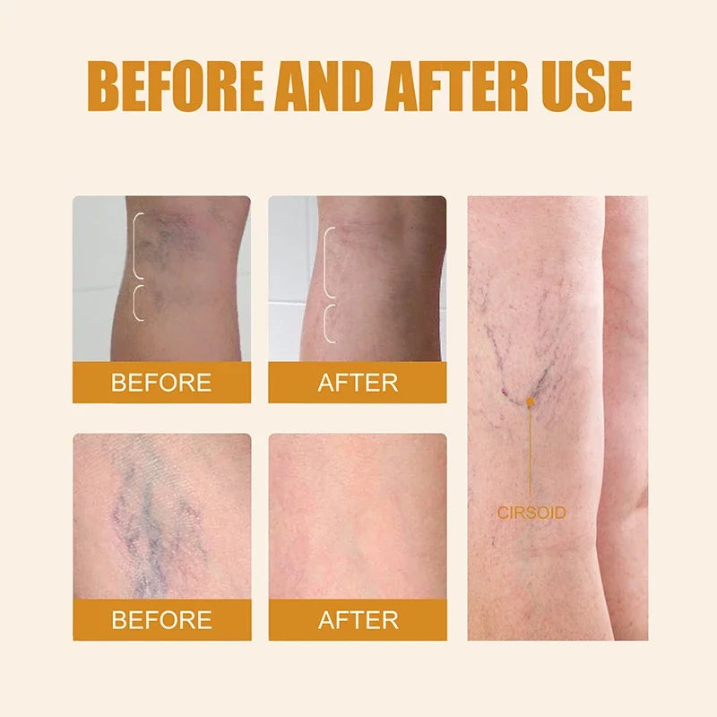 Laser Therapy Pen for Varicose Veins | Blue Light Treatment Device for Pain Relief & Circulation Improvement